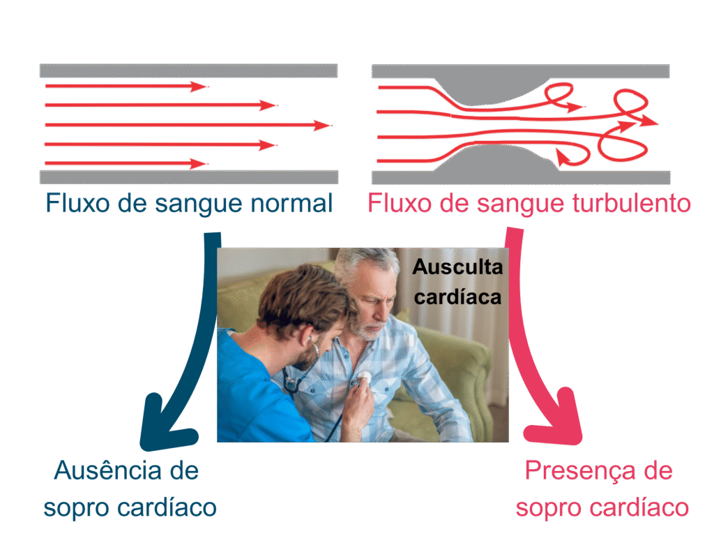 Sopro no coração, sopro cardíaco, doenças valvares cardíacas, insuficiência valvar, estenose valvar