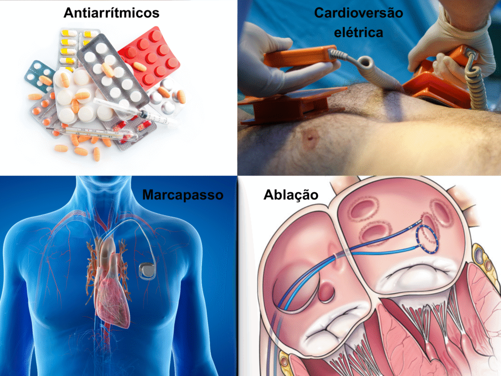 Coração Acelerado, Batimentos cardíacos baixos, Palpitação no coração, Fibrilação Atrial, Antiarrítmicos, Ablação, Marcapasso, CDI