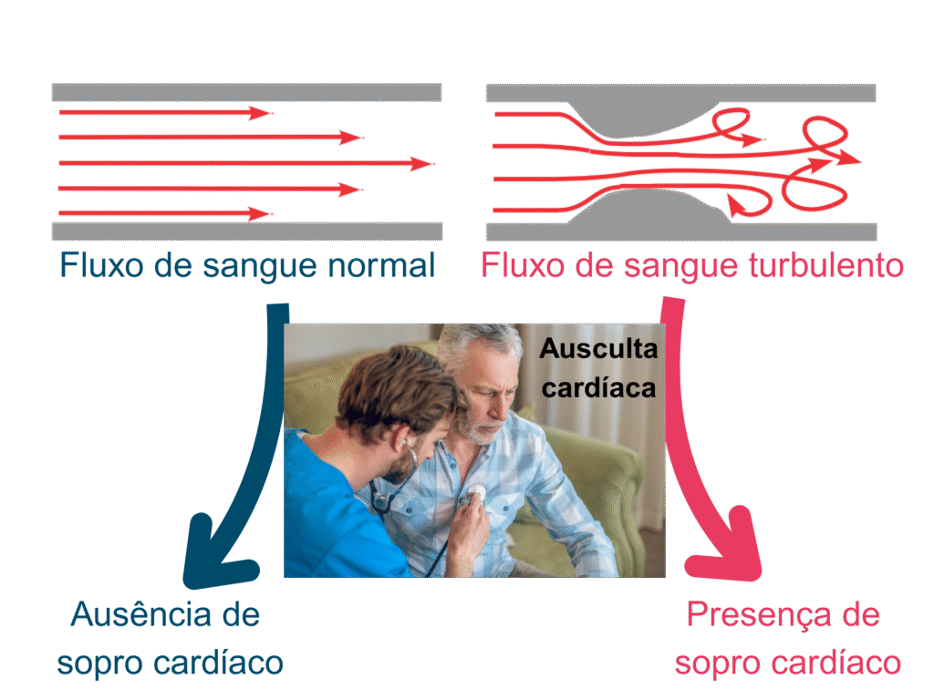 Sopro no coração, sopro cardíaco, doenças valvares cardíacas, insuficiência valvar, estenose valvar